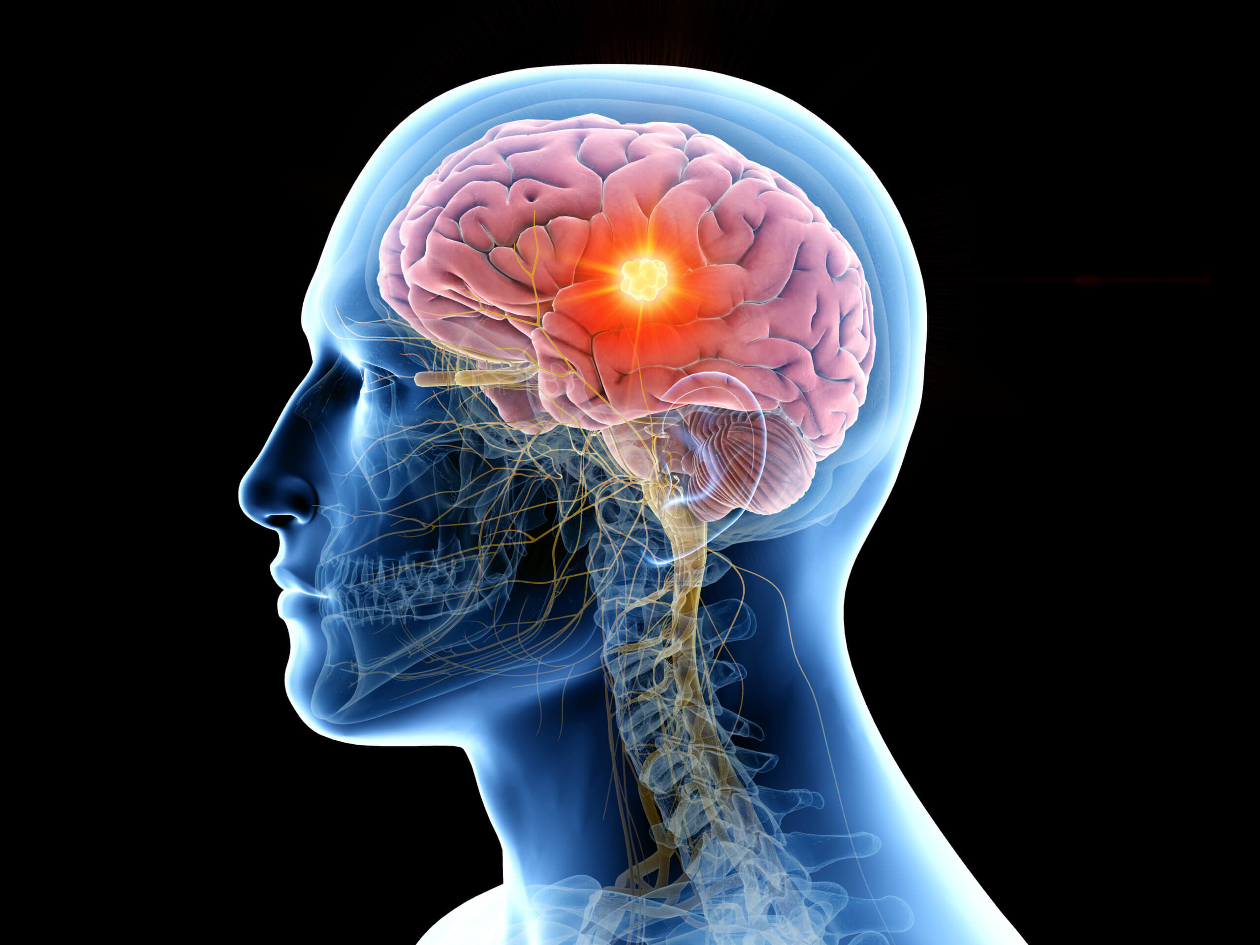 A Traumatic Brain Injury: What To Do - Deldar Legal
